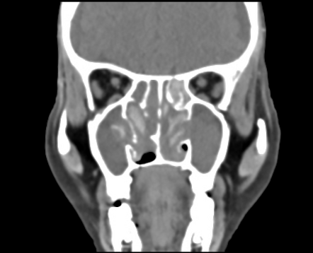 Allergic fungal rhinosinusitis | Radiology Case | Radiopaedia.org