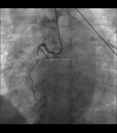 Severe stenosis right coronary artery on coronary catheterization ...