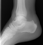 Bilateral deals retrocalcaneal bursitis