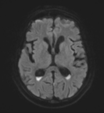 Pneumococcal meningitis with ventriculitis | Radiology Case ...