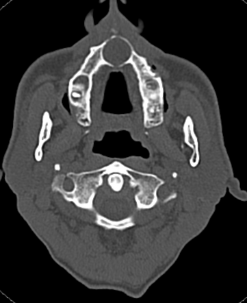 Incisive canal cyst | Radiology Case | Radiopaedia.org