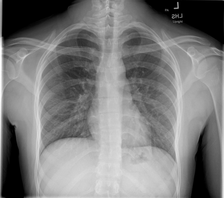 Normal chest radiograph | Radiology Case | Radiopaedia.org