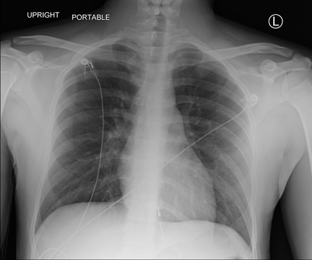 Normal Chest Radiograph Pediatric Radiology Case Radiopaedia Org