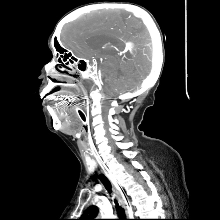 Basilar artery occlusion | Radiology Case | Radiopaedia.org