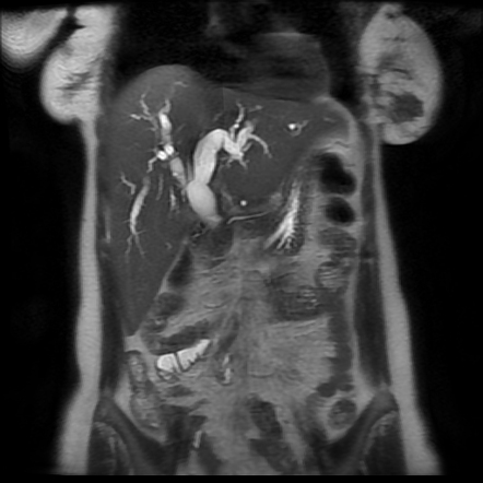 Choledochal cyst - type I | Radiology Case | Radiopaedia.org