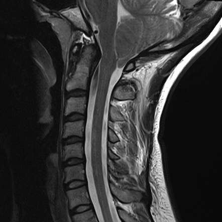 Chiari 1 Malformation With Decompression 