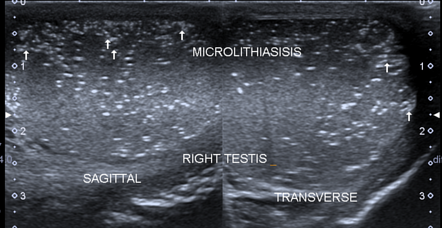 Testicular microlithiasis | Radiology Case | Radiopaedia.org