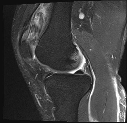 Anterior suprapatellar fat pad impingement syndrome | Radiology Case ...