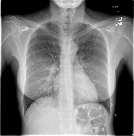 Normal chest radiograph | Radiology Case | Radiopaedia.org