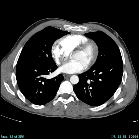 Sternal fracture with retrosternal haematoma | Radiology Case ...