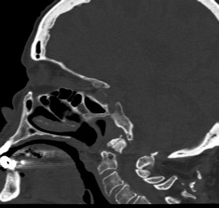 Type II dens fracture | Radiology Case | Radiopaedia.org