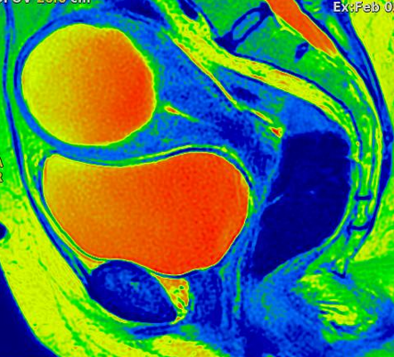 Uterine leiomyoma with cystic degeneration | Radiology Case ...