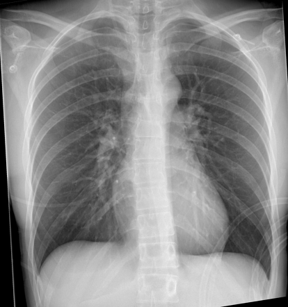 Normal chest radiograph | Radiology Case | Radiopaedia.org