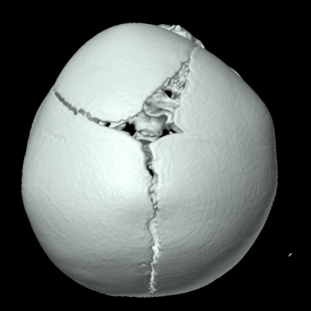 Plagiocephaly | Radiology Reference Article | Radiopaedia.org