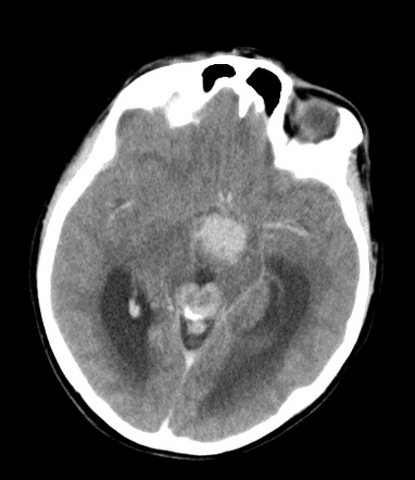 Synchronous pineal and suprasellar germinomas | Radiology Case ...