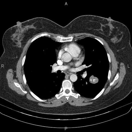 Pulmonary hamartoma | Radiology Case | Radiopaedia.org