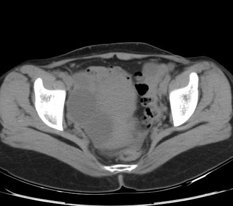 Hydrosalpinx | Image | Radiopaedia.org