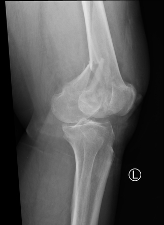 Distal Fracture Of The Femur 