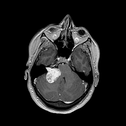 Vestibular schwannoma | Radiology Case | Radiopaedia.org