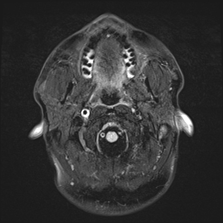 Internal carotid artery dissection | Radiology Case | Radiopaedia.org