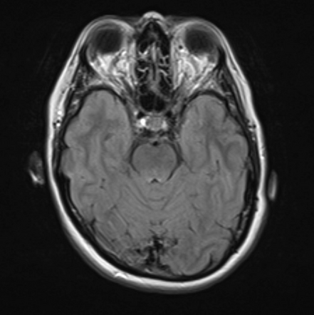 Caroticocavernous fistula - indirect | Radiology Case | Radiopaedia.org