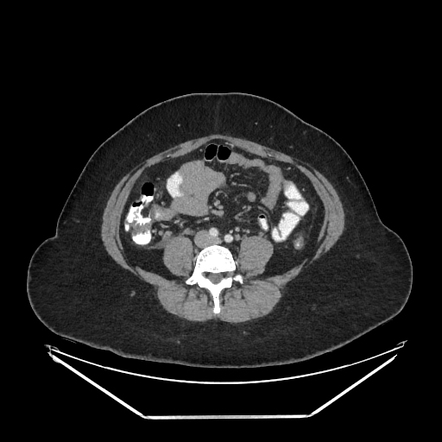 Ovarian dermoid cyst complicated by torsion | Radiology Case ...