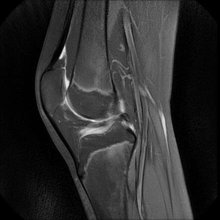 Discoid lateral meniscus | Radiology Case | Radiopaedia.org