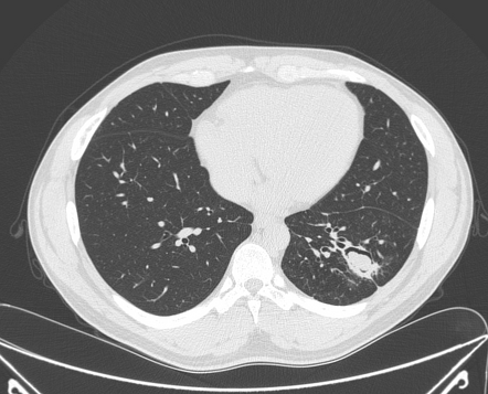 Pulmonary mycetoma | Radiology Case | Radiopaedia.org