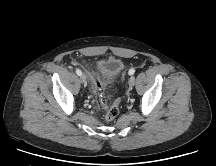 Acute Appendicitis | Radiology Reference Article | Radiopaedia.org