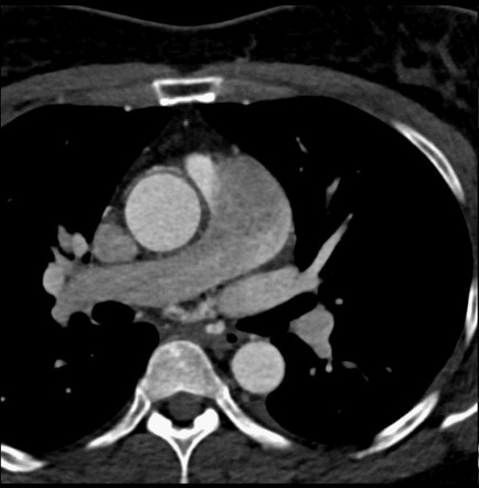 Anomalous right coronary artery arising from the pulmonary artery ...