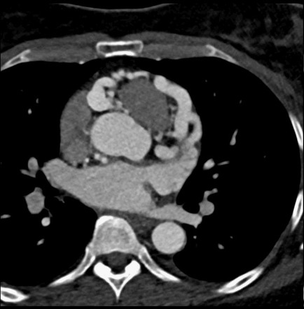 Anomalous right coronary artery from the pulmonary artery | Radiology ...