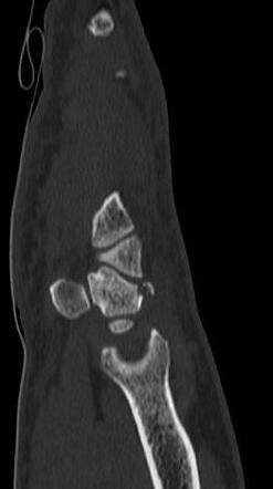 Triquetral fracture - pooping duck sign | Radiology Case | Radiopaedia.org