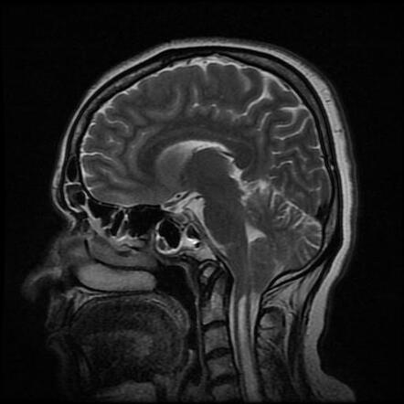 Chiari I malformation and extensive cervico-dorsal syringohydromyelia ...