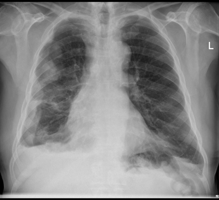 Mesothelioma | Radiology Case | Radiopaedia.org