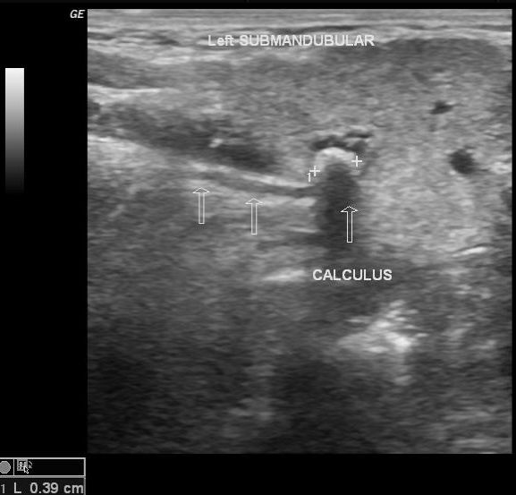 Sialolithiasis Submandibular Gland Image