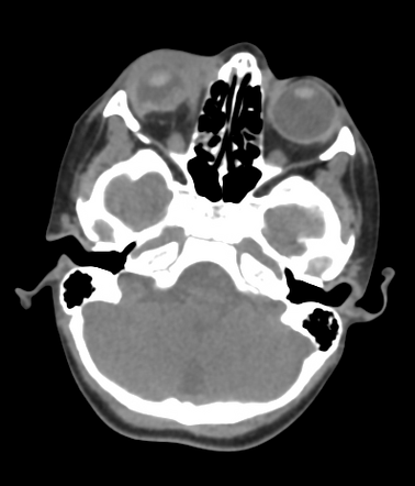 Flat tyre sign (globe rupture) | Radiology Reference Article ...