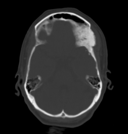 Intraosseous meningioma | Radiology Reference Article | Radiopaedia.org