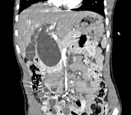 Choledochal cyst - type I | Radiology Case | Radiopaedia.org