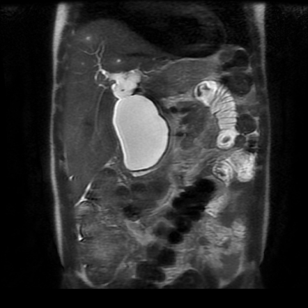 Choledochal cyst - type I with complications | Radiology Case ...