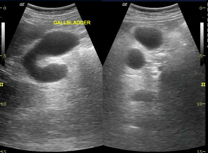 Gallbladder Duplication | Image | Radiopaedia.org