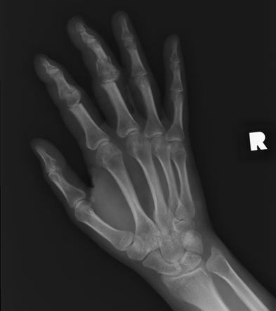 Snow blower hand injury | Radiology Case | Radiopaedia.org