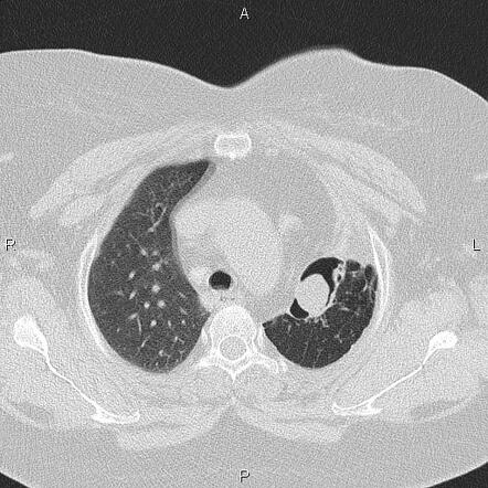 Aspergilloma | Radiology Case | Radiopaedia.org