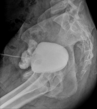 Augmentation cystoplasty | Radiology Case | Radiopaedia.org