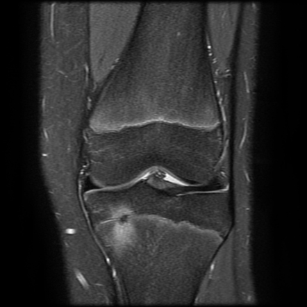 Focal periphyseal edema zone | Radiology Case | Radiopaedia.org