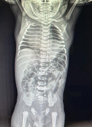 Bochdalek hernia | Radiology Case | Radiopaedia.org