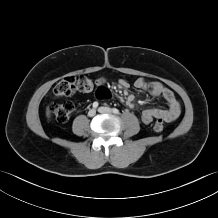 Mesenteric panniculitis | Radiology Case | Radiopaedia.org