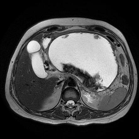 Necrotizing pancreatitis with walled-off necrotic collection ...