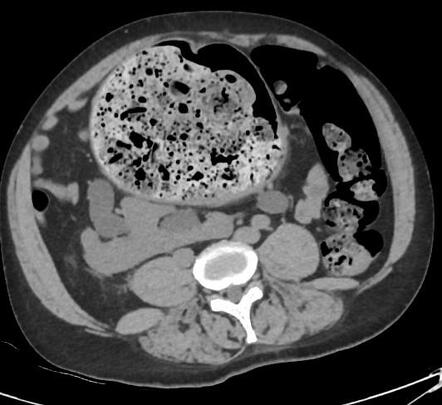 Crossed fused renal ectopia with bilateral hydronephrosis | Radiology ...