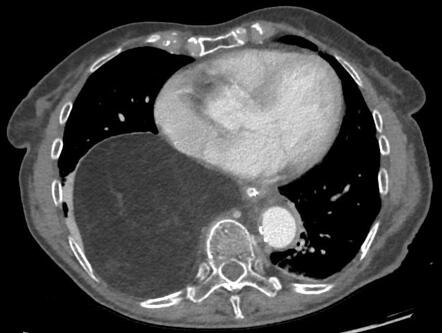 Pleural lipoma | Radiology Case | Radiopaedia.org