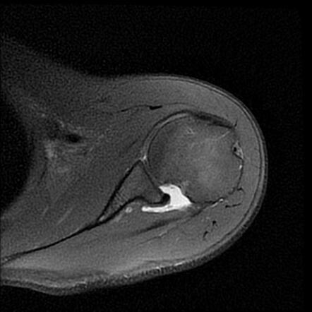 Anterior shoulder instability - recurrent | Radiology Case ...